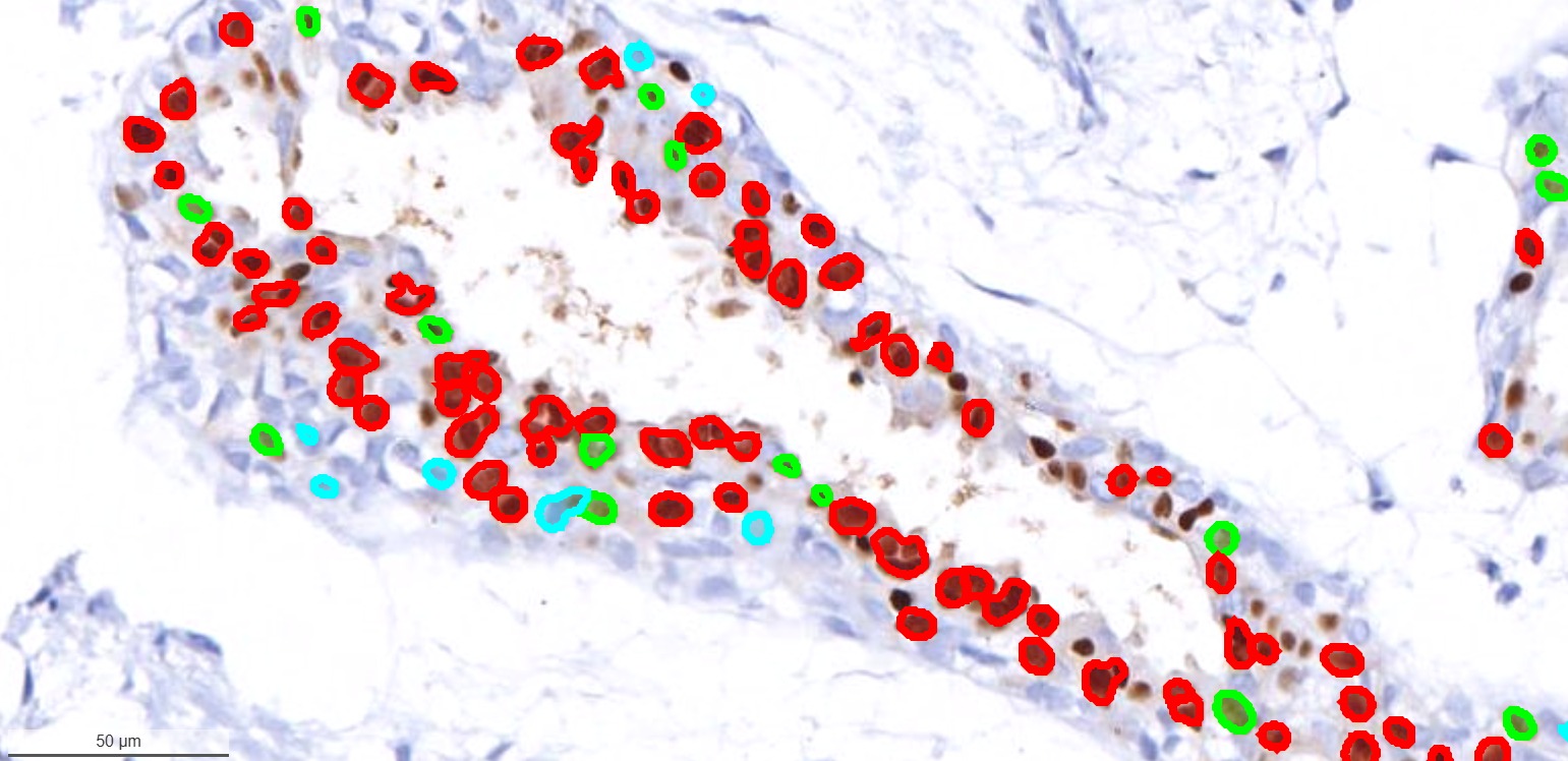 WSI region showing AI outlines of ER/PR positive breast cancer cells in red and green using Path Assist™ analysis