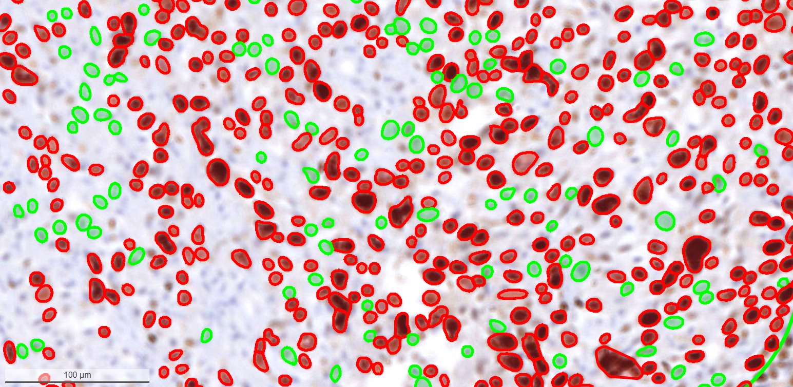 Ki-67 IHC whole-slide ROI showing AI outlines: red positive nuclei and green negative nuclei for proliferation measurement
