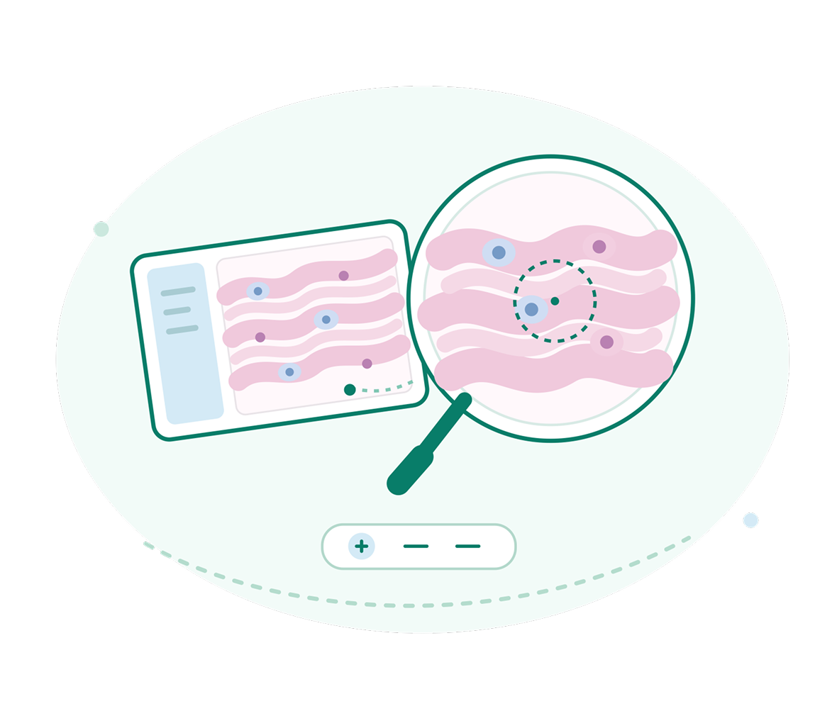 Illustration of a lab report and magnifying glass revealing pink tissue layers with colored cells and a highlighted area, suggesting careful medical analysis.